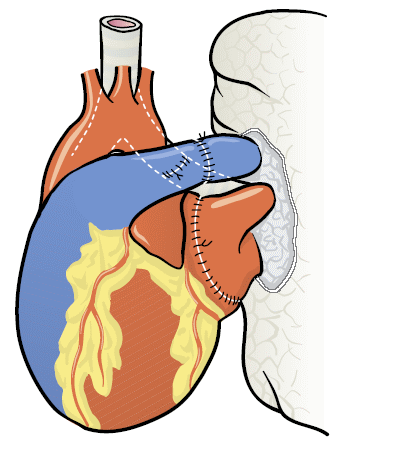 Lungentransplantation